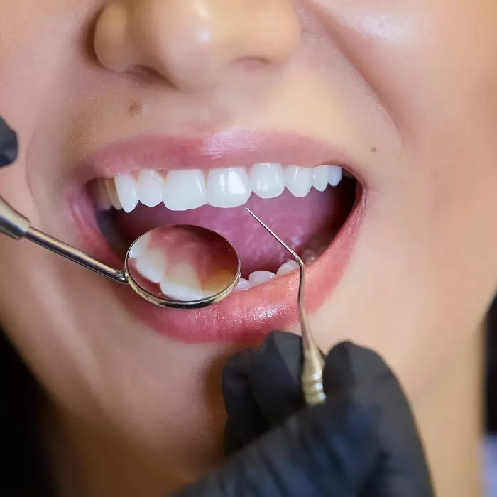 Prevenção em periodontia: a importância da orientação dos pacientes